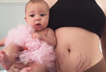 This mum is celebrating her post-baby stretch marks in the most beautiful way