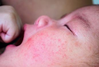Eczema in children: How to relieve their painful itching