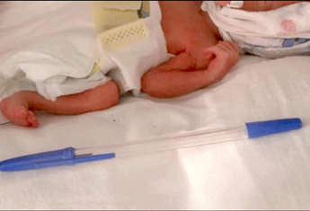 A premature baby born the ‘size of a pen’ reaches healthy weight after four months of care